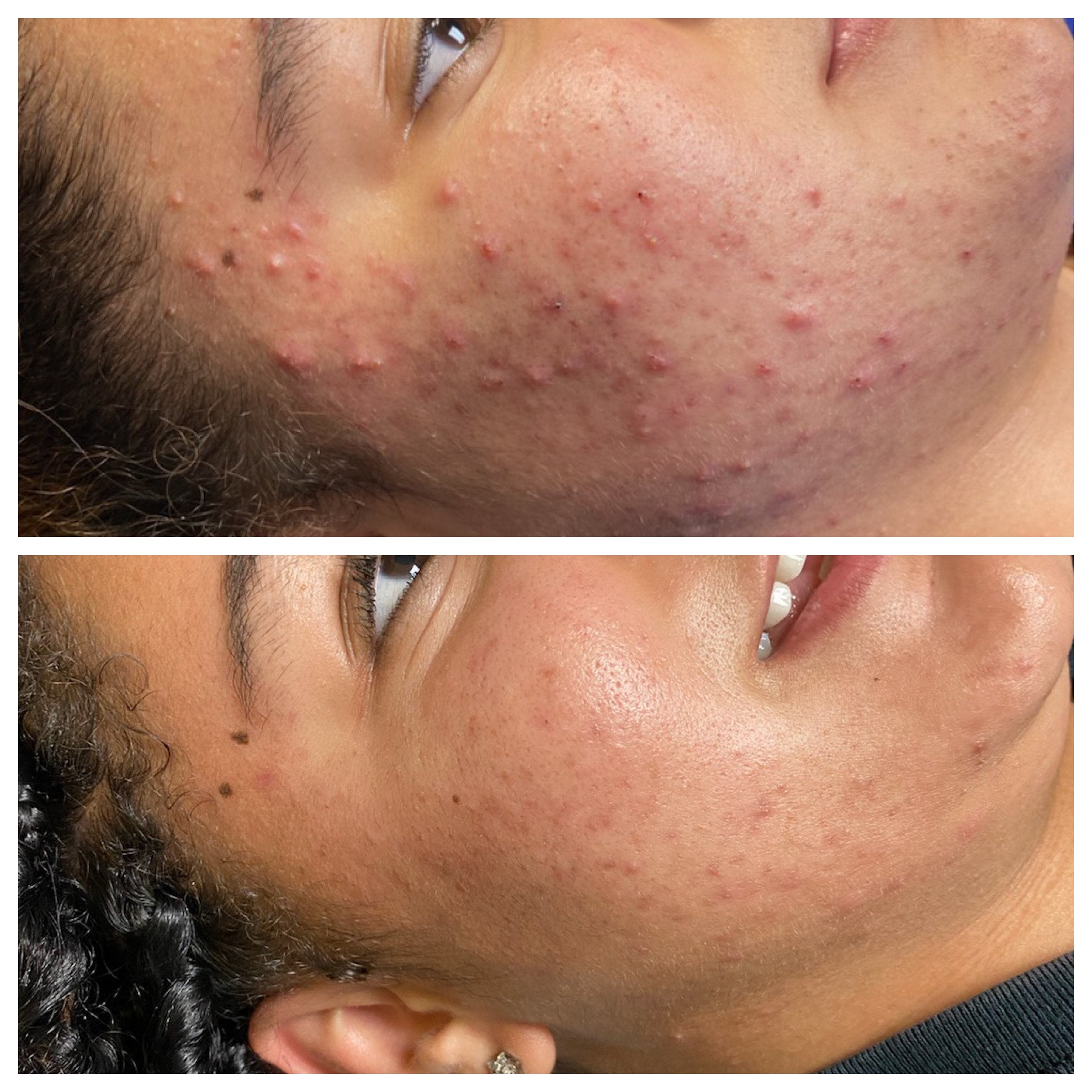 Clear Skin 10% 1.7 oz