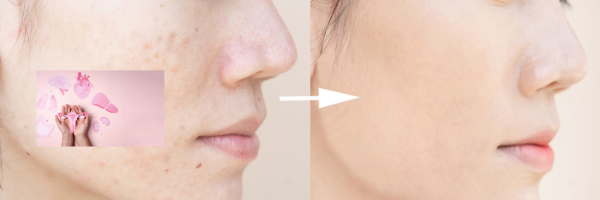 Understanding the Link Between Acne and PCOS: A Comprehensive Guide for Effective Treatment