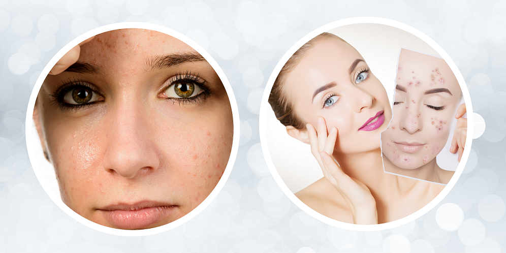 Understanding How Hormones Affect Acne: An In-Depth Look